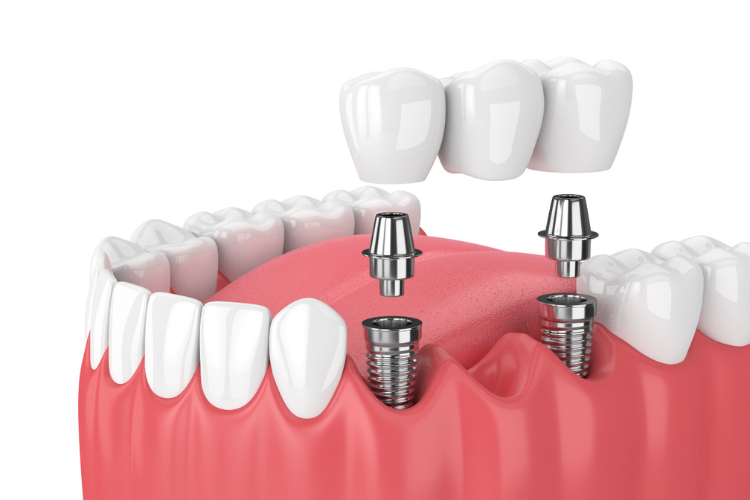 trồng răng implant nhổ răng khôn nha trang