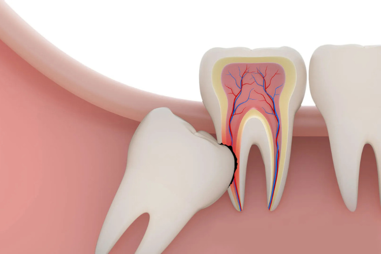 trồng răng implant nhổ răng khôn nha trang